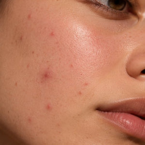 Acné e imperfecciones
